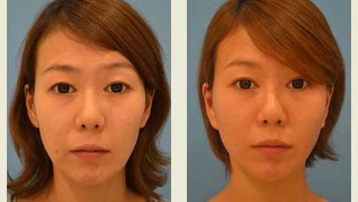 フェイスリフト：頬の脂肪吸引後のたるみ修正