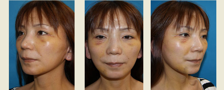 フェイスリフト＋ケーブルスーチャーによる頬部脂肪の挙上　手術1週間後の経過写真