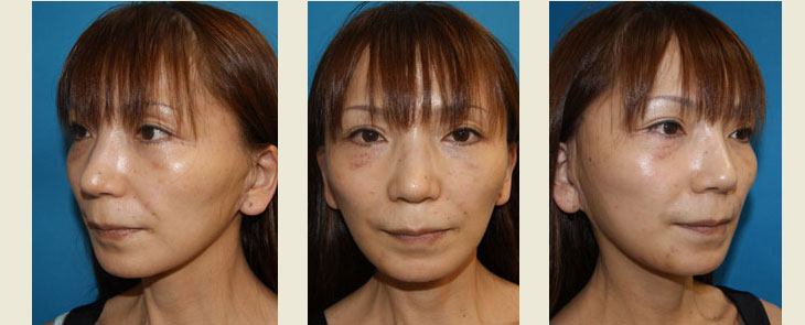 フェイスリフト＋ケーブルスーチャーによる頬部脂肪の挙上　手術2週間後の経過写真