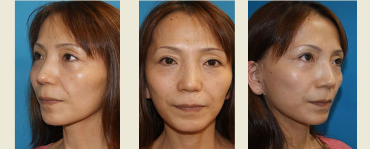 フェイスリフト＋ケーブルスーチャーによる頬部脂肪の挙上　手術1ヶ月後の経過写真