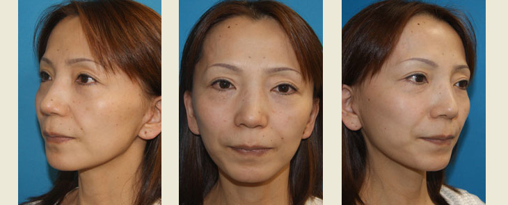 フェイスリフト＋ケーブルスーチャーによる頬部脂肪の挙上　手術2ヶ月後の経過写真