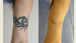 腕の刺青分割切除術（タトゥー除去）