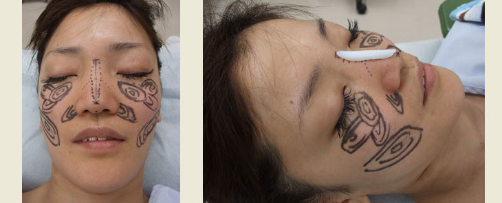 隆鼻術（プロテーゼ挿入術）＋脂肪注入　術前デザイン