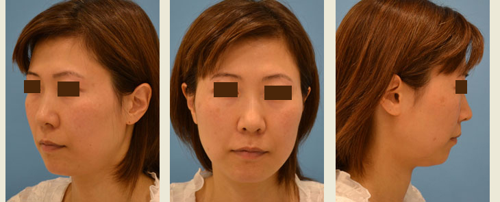 ロウアーフェイスリフト＋（１か月後の）中顔面のシルエットリフトの手術経過