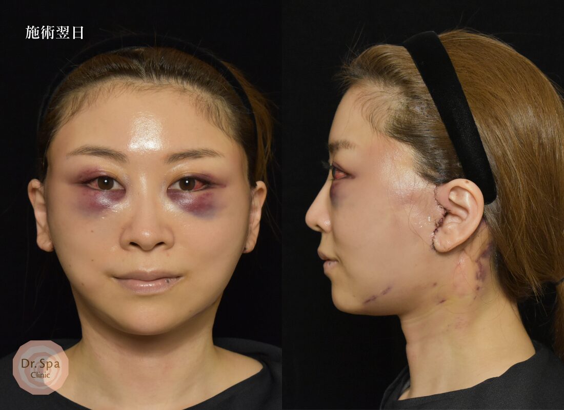 フェイスリフト手術　手術翌日