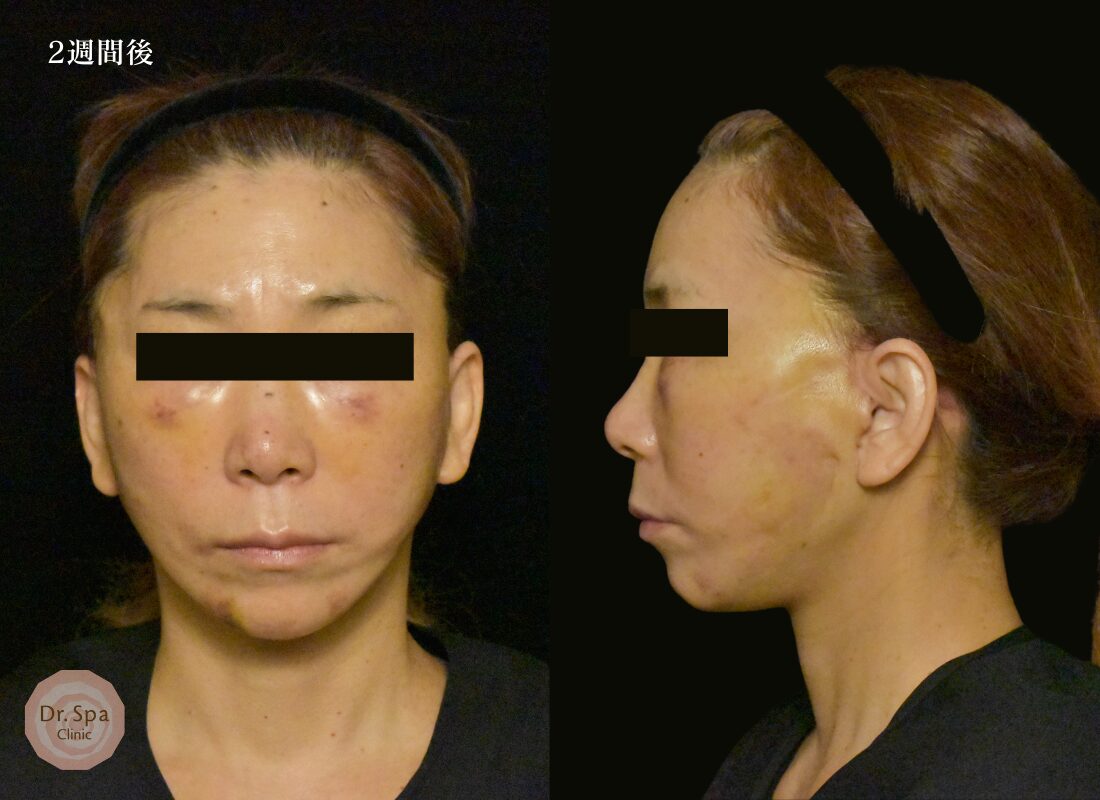 フェイスリフト手術　術後2週間の経過写真