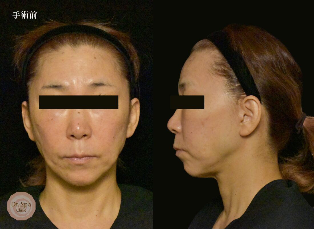 術前の写真