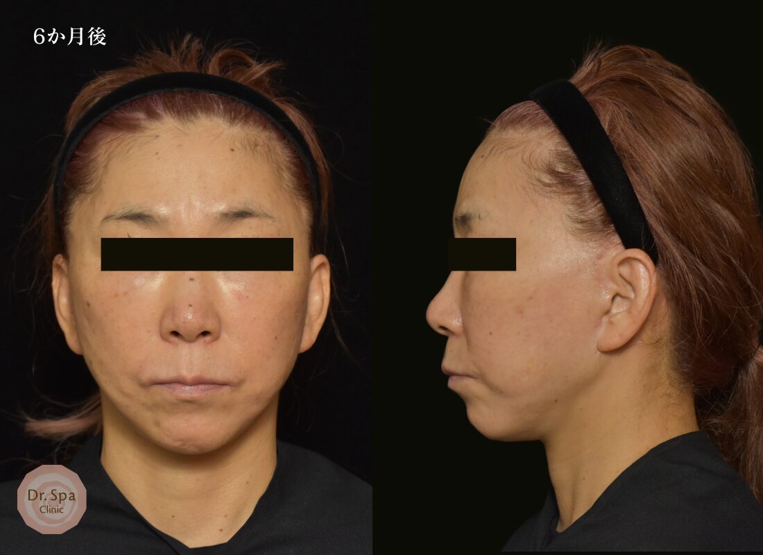 フェイスリフト手術　術後6か月の経過写真