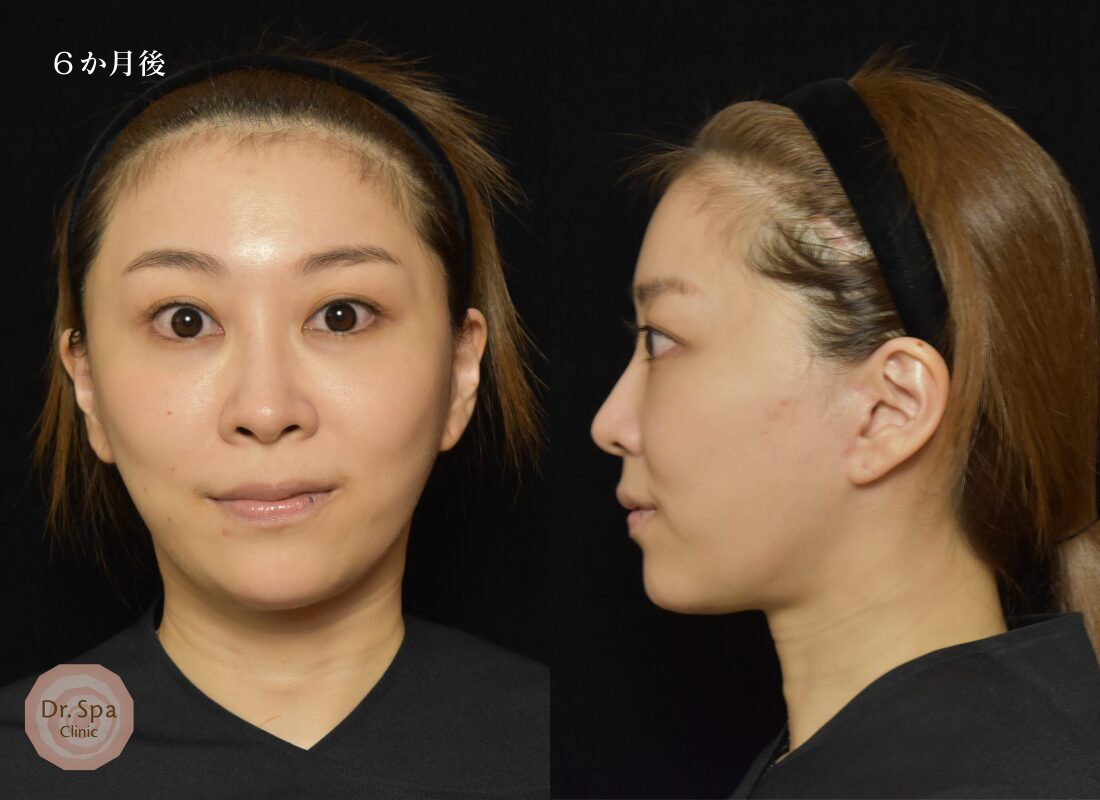 フェイスリフト手術　術後6か月の経過写真