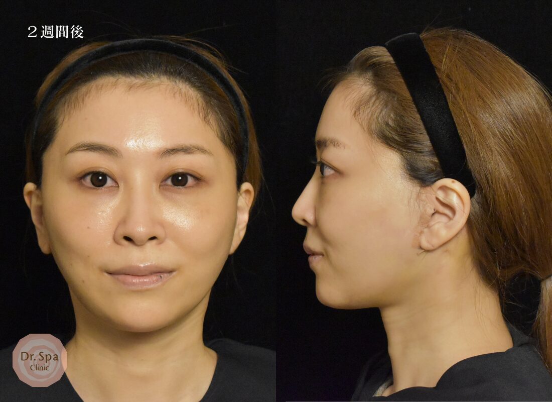 フェイスリフト手術　術後2週間の経過写真