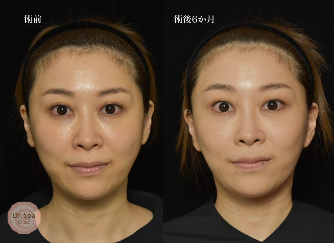 フェイスリフト手術　術後6か月の比較写真　正面