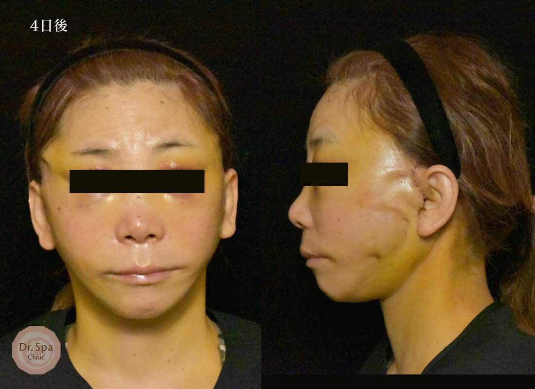 フェイスリフト手術　術後4日目の経過写真