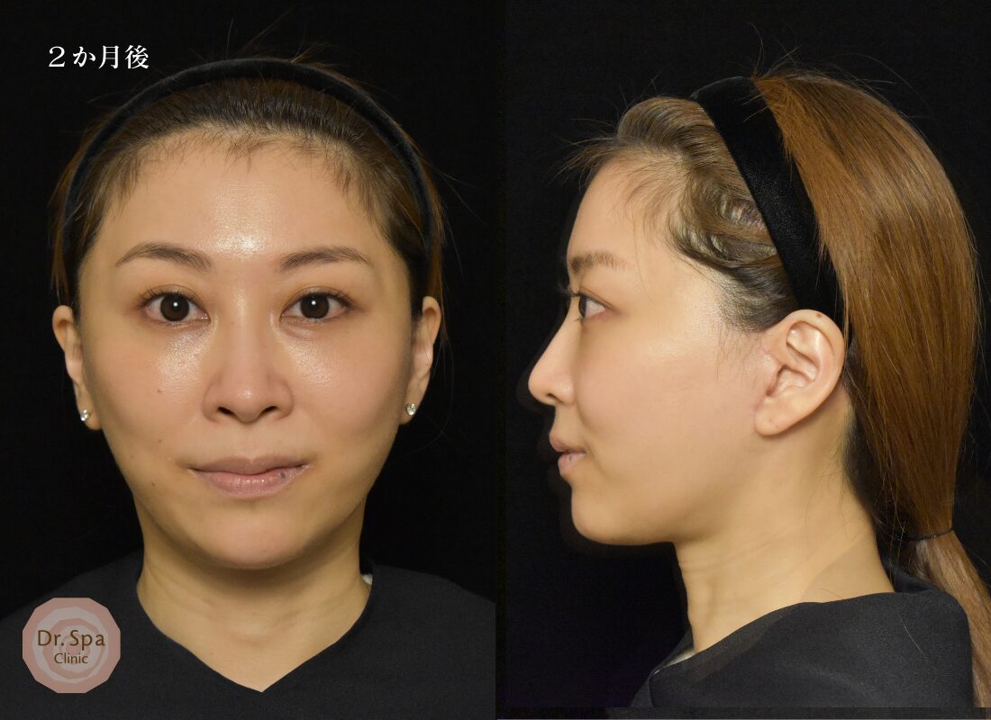 フェイスリフト手術　術後2か月の経過写真