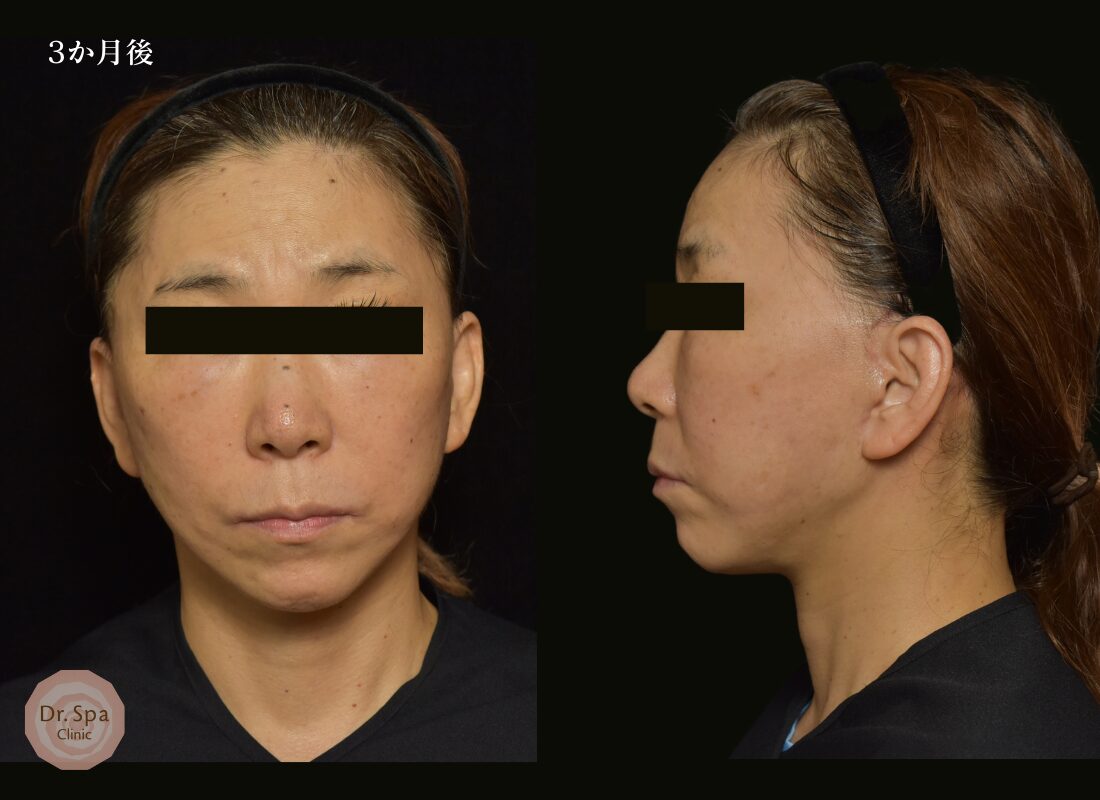 フェイスリフト手術　術後3か月の経過写真