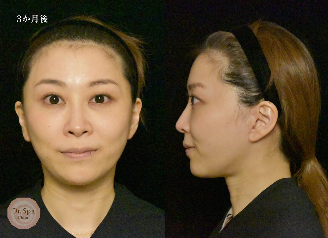 フェイスリフト手術　術後3か月の経過写真