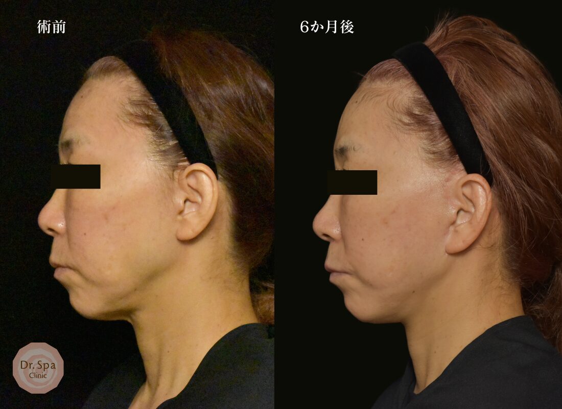 フェイスリフト手術　術後6か月の比較写真　横