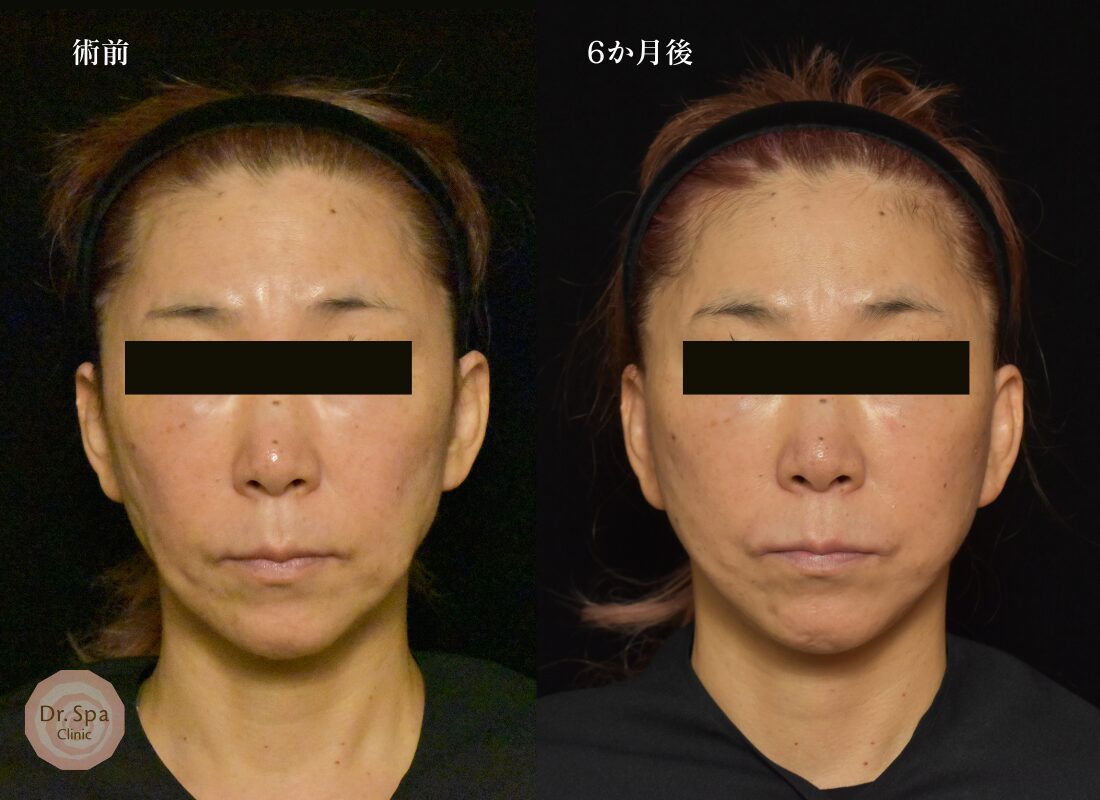 プレミアムフェイスリフト手術