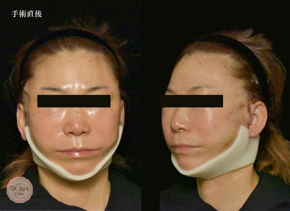 フェイスリフト手術　手術直後