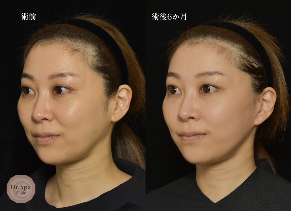 プレミアムフェイスリフト手術