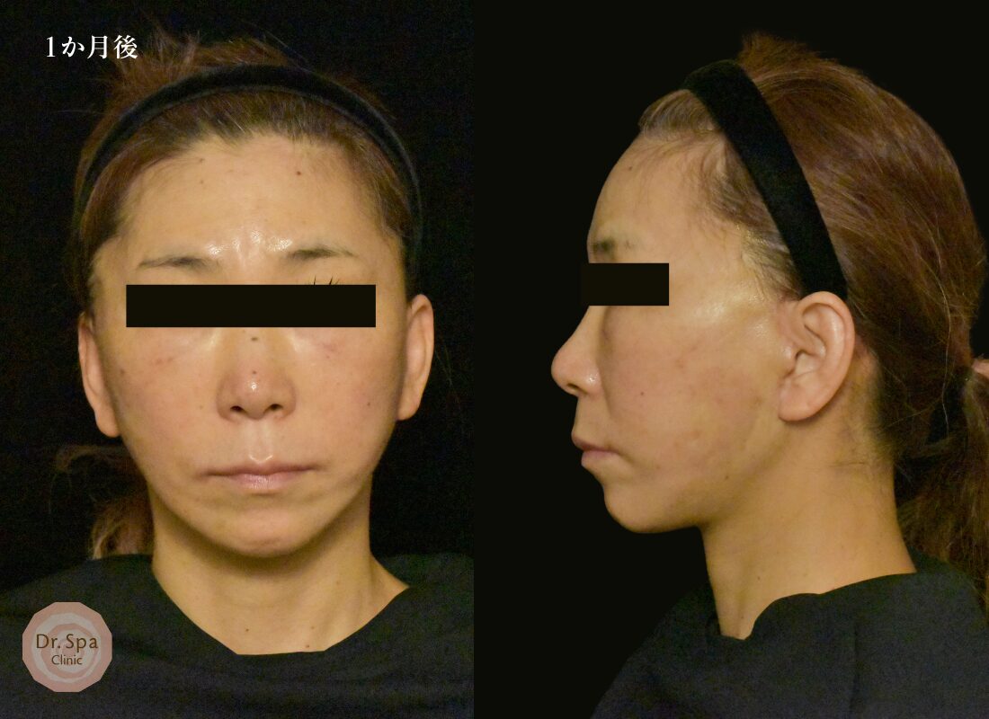 フェイスリフト手術　術後1か月の経過写真