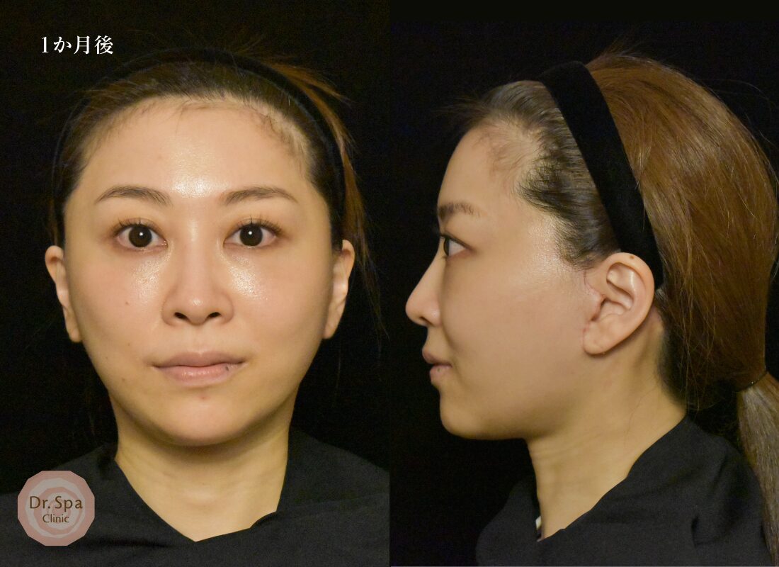 フェイスリフト手術　術後1か月の経過写真