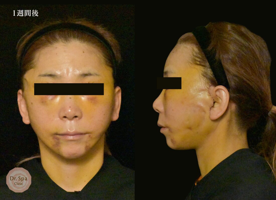 フェイスリフト手術　術後1週間の経過写真