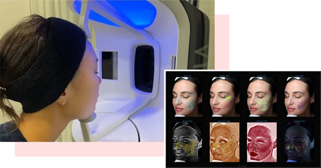 VISIA肌診断の様子と解析画面
